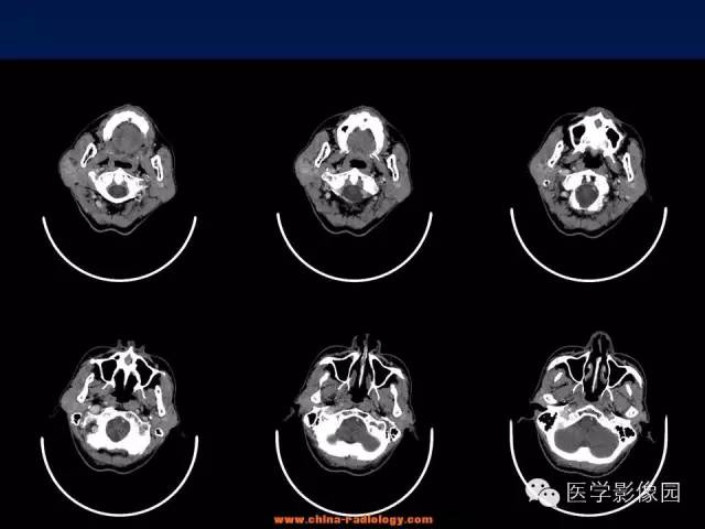 【病例】腮腺基底细胞腺瘤1例CT影像表现