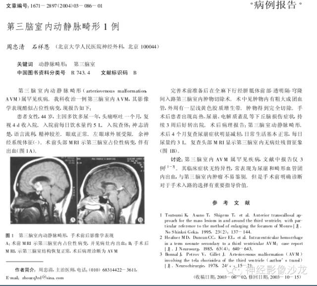 【病例】第三脑室动静脉畸形1例MR影像表现