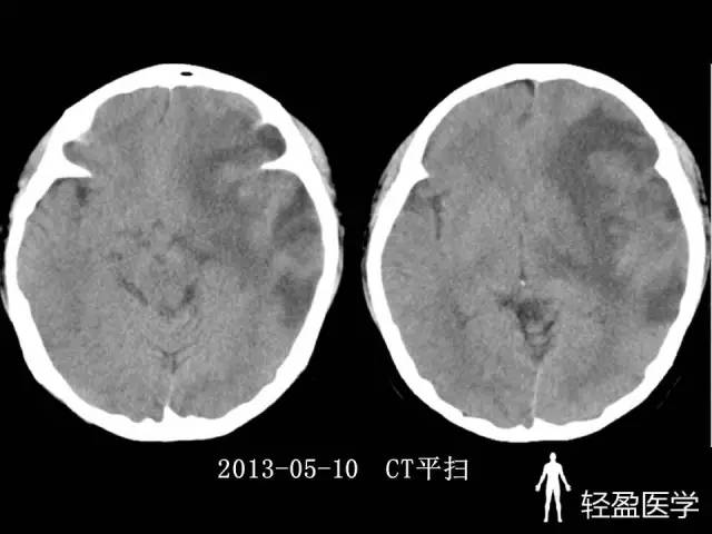 【病例】大脑中静脉血栓1例——神经疑难病例诊断思路应该这样！