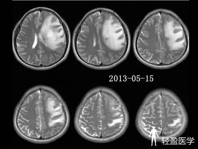 【病例】大脑中静脉血栓1例——神经疑难病例诊断思路应该这样! 【病例】大脑中静脉血栓1例——神经疑难病例诊断思路应该这样!