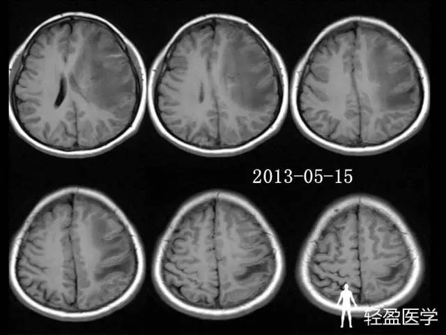 【病例】大脑中静脉血栓1例——神经疑难病例诊断思路应该这样! 【病例】大脑中静脉血栓1例——神经疑难病例诊断思路应该这样!