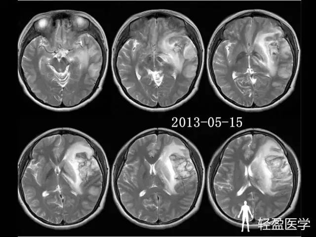 【病例】大脑中静脉血栓1例——神经疑难病例诊断思路应该这样! 【病例】大脑中静脉血栓1例——神经疑难病例诊断思路应该这样!