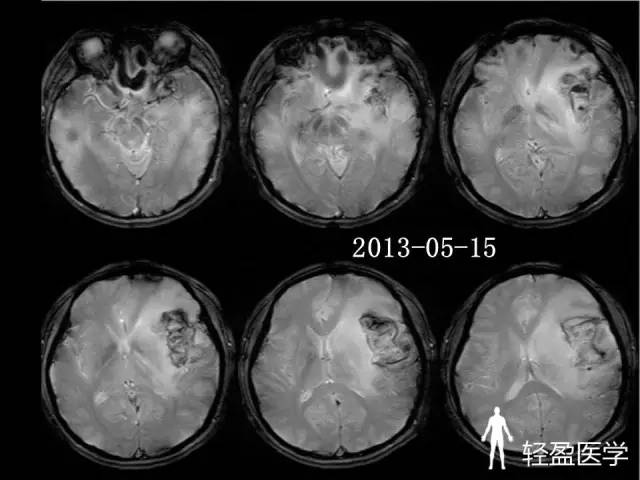 【病例】大脑中静脉血栓1例——神经疑难病例诊断思路应该这样! 【病例】大脑中静脉血栓1例——神经疑难病例诊断思路应该这样!
