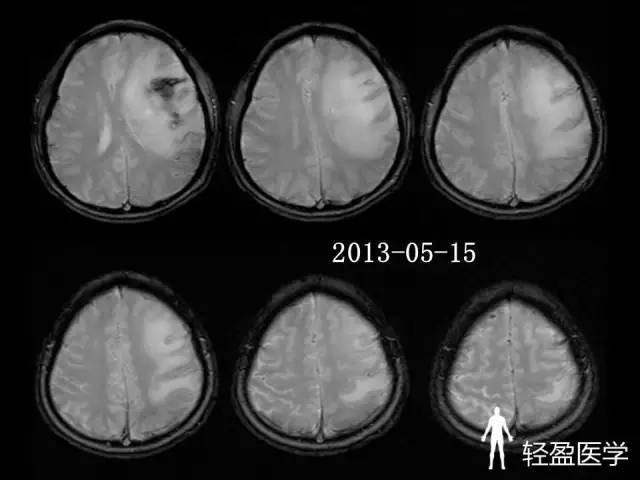 【病例】大脑中静脉血栓1例——神经疑难病例诊断思路应该这样! 【病例】大脑中静脉血栓1例——神经疑难病例诊断思路应该这样!