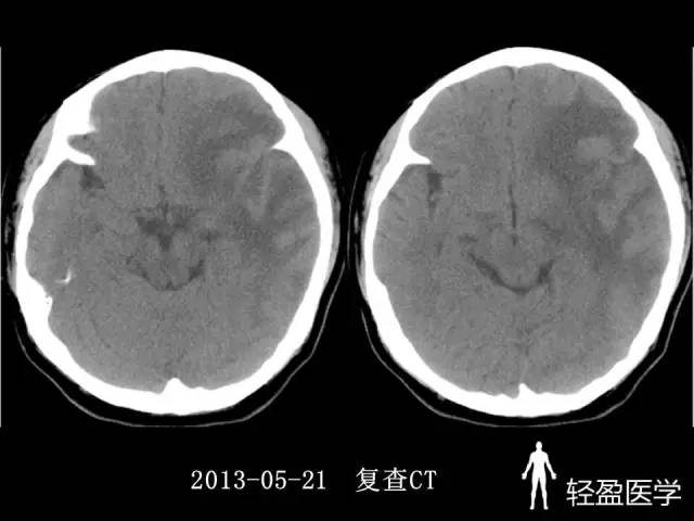 【病例】大脑中静脉血栓1例——神经疑难病例诊断思路应该这样! 【病例】大脑中静脉血栓1例——神经疑难病例诊断思路应该这样!