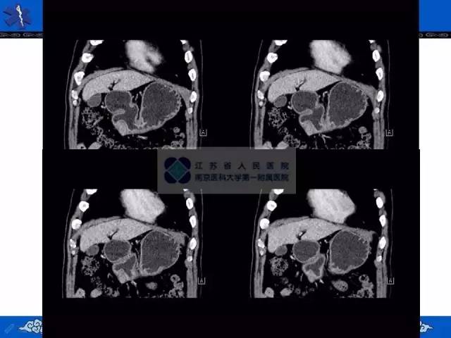 【病例】胃间质瘤1例CT影像表现 【病例】胃间质瘤1例CT影像表现