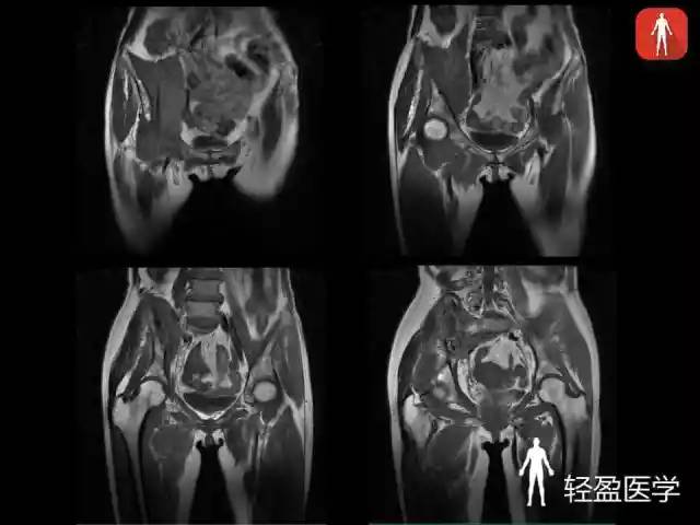 【病例】骶髂关节结核1例MR影像表现