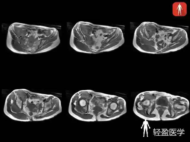 【病例】骶髂关节结核1例MR影像表现