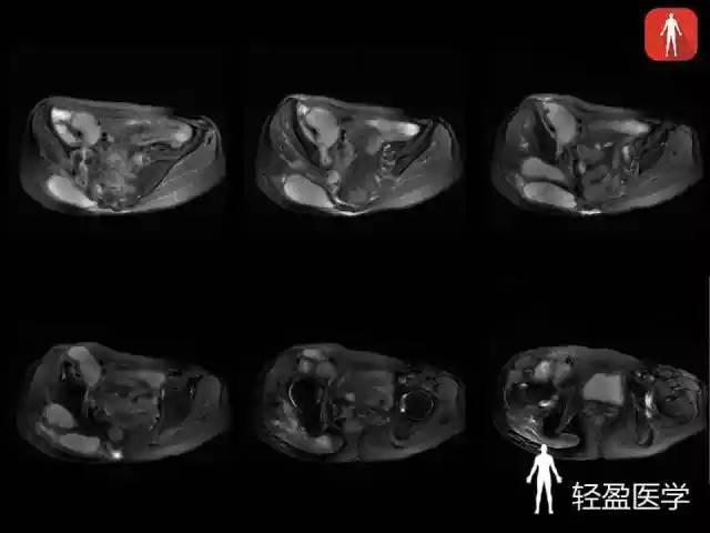 【病例】骶髂关节结核1例MR影像表现