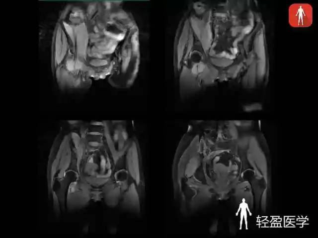 【病例】骶髂关节结核1例MR影像表现