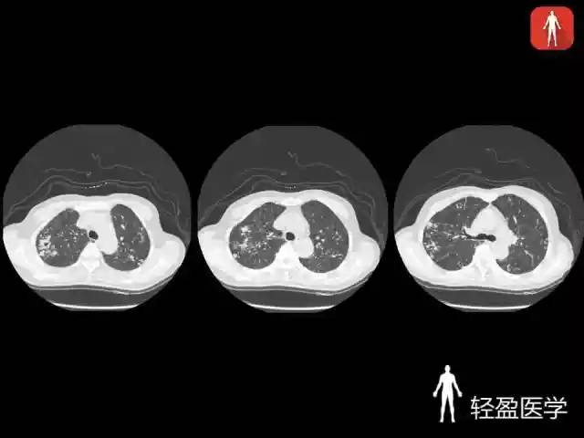【病例】骶髂关节结核1例MR影像表现