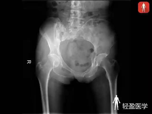 【病例】骶髂关节结核1例MR影像表现