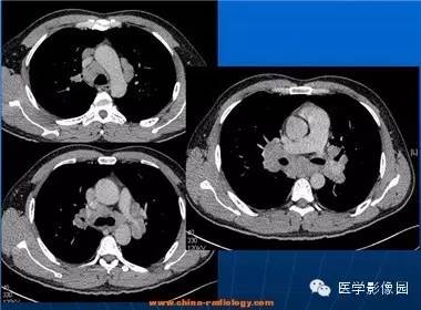 【病例】肺结节病1例CT影像表现 【病例】肺结节病1例CT影像表现