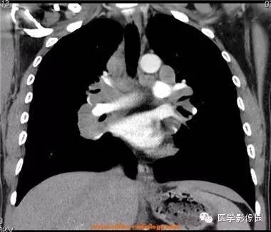 【病例】肺结节病1例CT影像表现 【病例】肺结节病1例CT影像表现