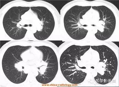 【病例】肺结节病1例CT影像表现 【病例】肺结节病1例CT影像表现