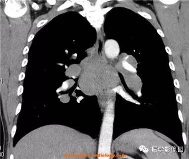 【病例】肺结节病1例CT影像表现 【病例】肺结节病1例CT影像表现