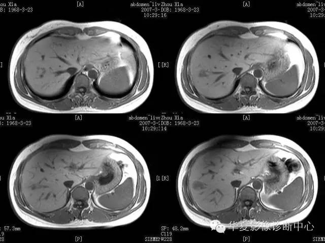 【病例】肝孤立性坏死结节1例MR影像表现