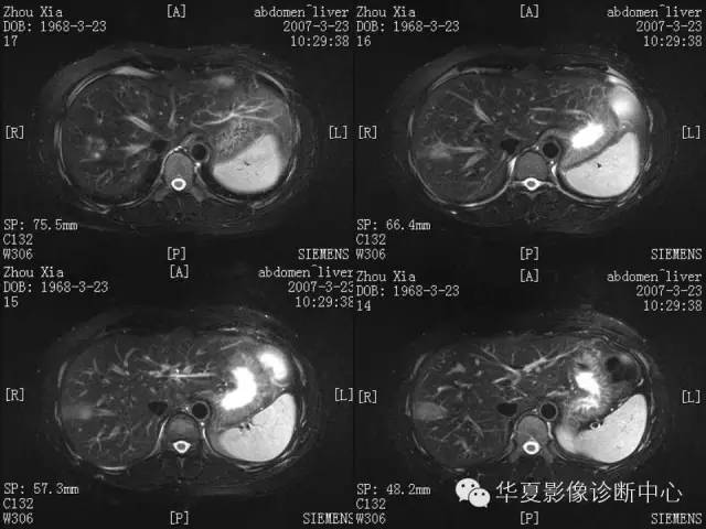【病例】肝孤立性坏死结节1例MR影像表现