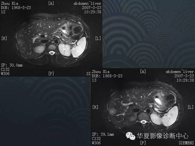 【病例】肝孤立性坏死结节1例MR影像表现