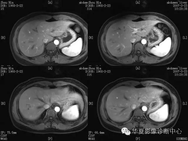 【病例】肝孤立性坏死结节1例MR影像表现