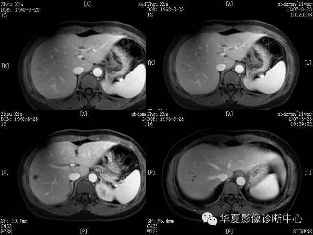 【病例】肝孤立性坏死结节1例MR影像表现