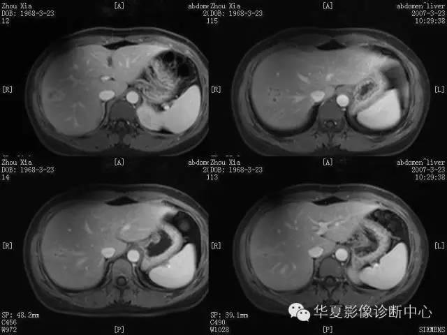 【病例】肝孤立性坏死结节1例MR影像表现