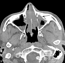 鼻腔常见疾病的鉴别诊断