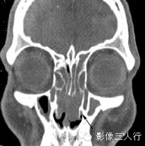 鼻腔常见疾病的鉴别诊断 鼻腔常见疾病的鉴别诊断