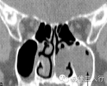 鼻腔常见疾病的鉴别诊断 鼻腔常见疾病的鉴别诊断