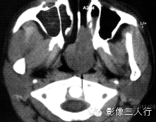 鼻腔常见疾病的鉴别诊断 鼻腔常见疾病的鉴别诊断
