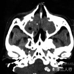 鼻腔常见疾病的鉴别诊断 鼻腔常见疾病的鉴别诊断