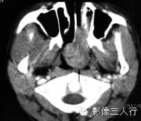 鼻腔常见疾病的鉴别诊断 鼻腔常见疾病的鉴别诊断