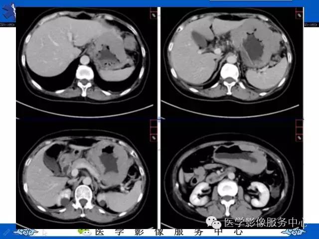 【病例】胃淋巴瘤1例CT影像表现