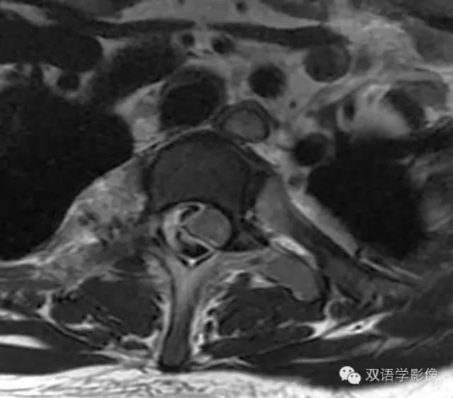 【双语病例】产后自发性椎管内硬膜外血肿1例 【双语病例】产后自发性椎管内硬膜外血肿1例