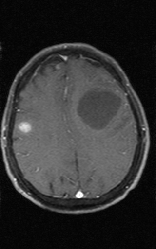 【病例】脑转移瘤1例MR影像表现 【病例】脑转移瘤1例MR影像表现