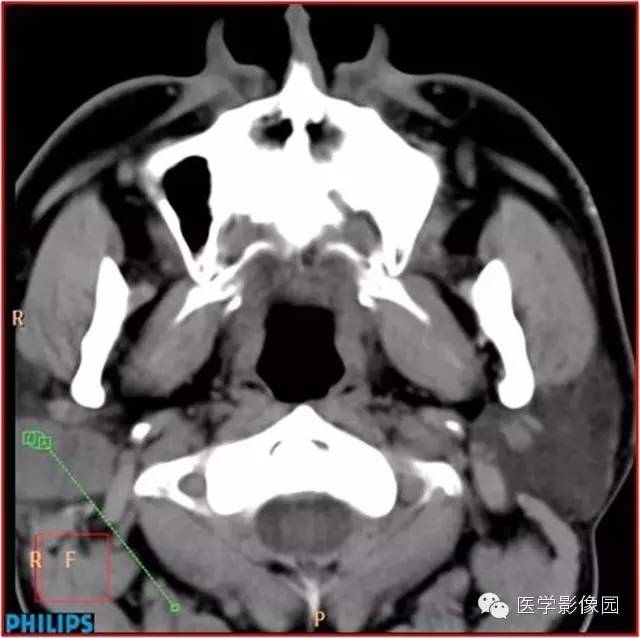 【病例】腮腺肌上皮瘤1例CT影像表现 【病例】腮腺肌上皮瘤1例CT影像表现