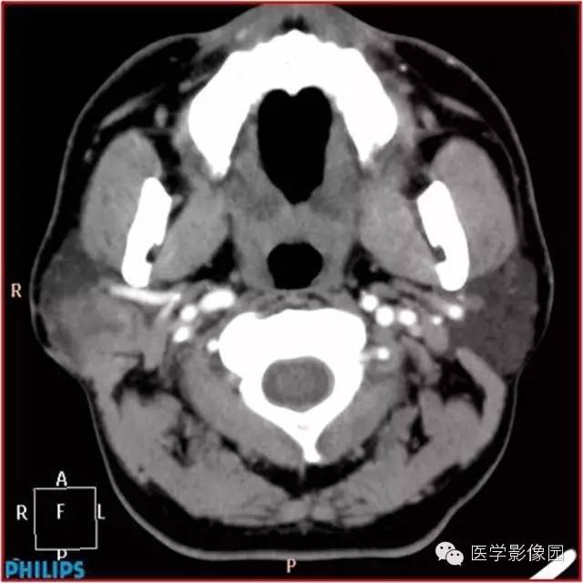 【病例】腮腺肌上皮瘤1例CT影像表现 【病例】腮腺肌上皮瘤1例CT影像表现