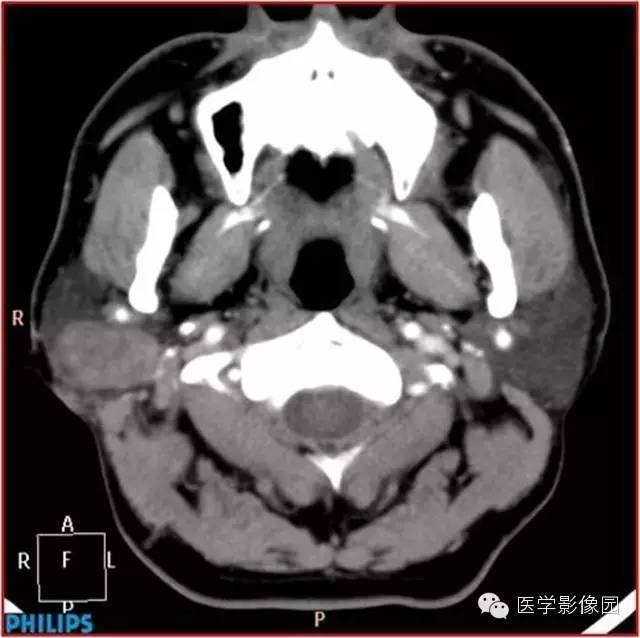 【病例】腮腺肌上皮瘤1例CT影像表现 【病例】腮腺肌上皮瘤1例CT影像表现