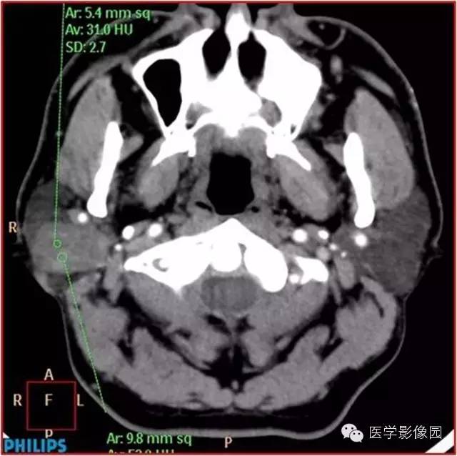 【病例】腮腺肌上皮瘤1例CT影像表现 【病例】腮腺肌上皮瘤1例CT影像表现
