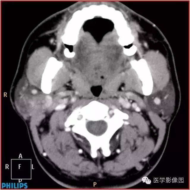 【病例】腮腺肌上皮瘤1例CT影像表现 【病例】腮腺肌上皮瘤1例CT影像表现