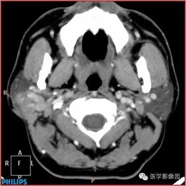 【病例】腮腺肌上皮瘤1例CT影像表现 【病例】腮腺肌上皮瘤1例CT影像表现