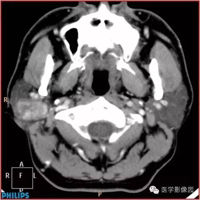 【病例】腮腺肌上皮瘤1例CT影像表现 【病例】腮腺肌上皮瘤1例CT影像表现