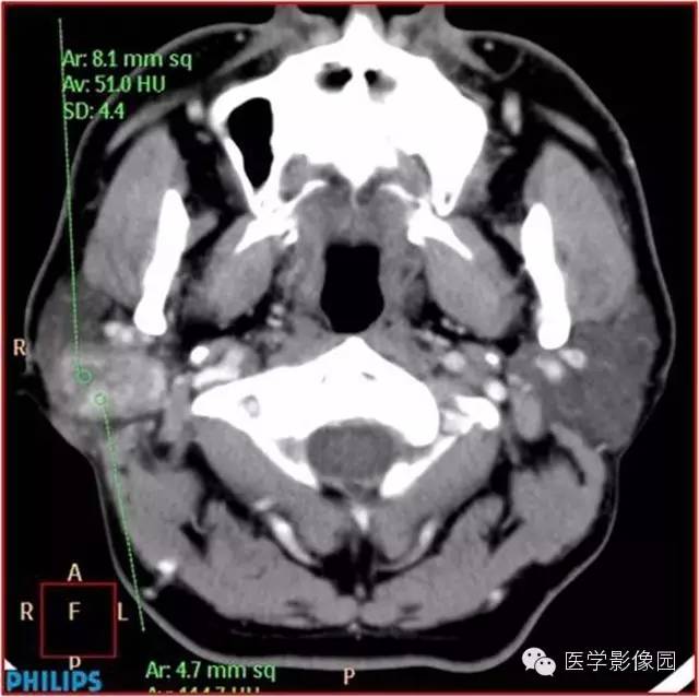 【病例】腮腺肌上皮瘤1例CT影像表现 【病例】腮腺肌上皮瘤1例CT影像表现