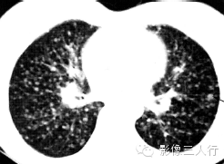 3种肺内多发结节的CT鉴别