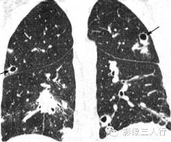 3种肺内多发结节的CT鉴别