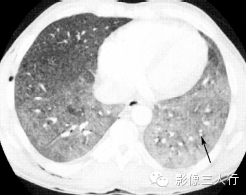 3种肺内多发结节的CT鉴别