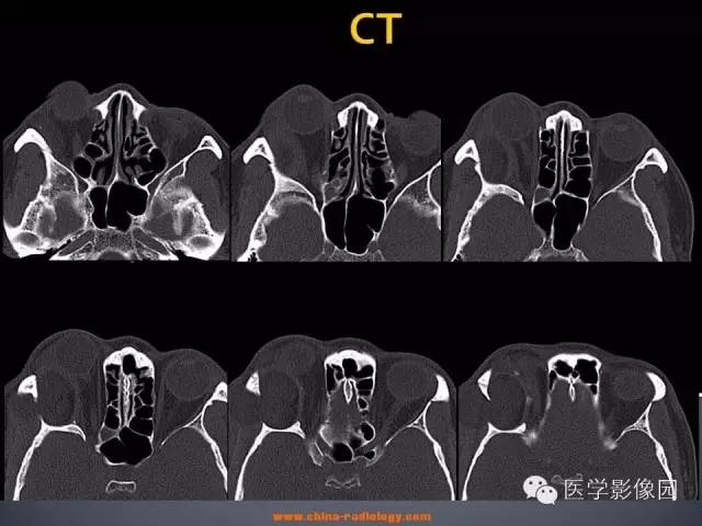 【病例】眼眶表皮样囊肿1例CT及MR影像表现