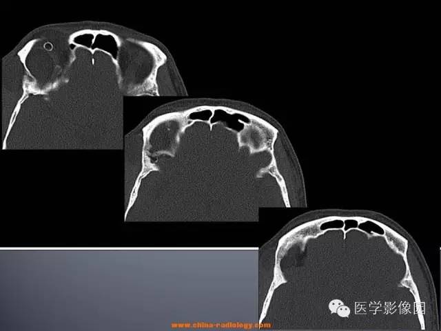 【病例】眼眶表皮样囊肿1例CT及MR影像表现