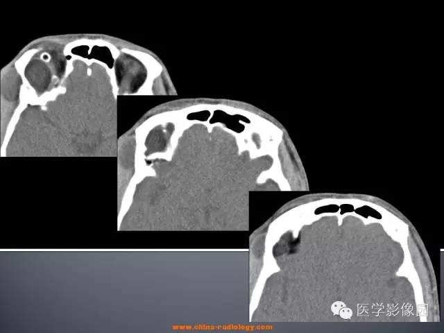 【病例】眼眶表皮样囊肿1例CT及MR影像表现