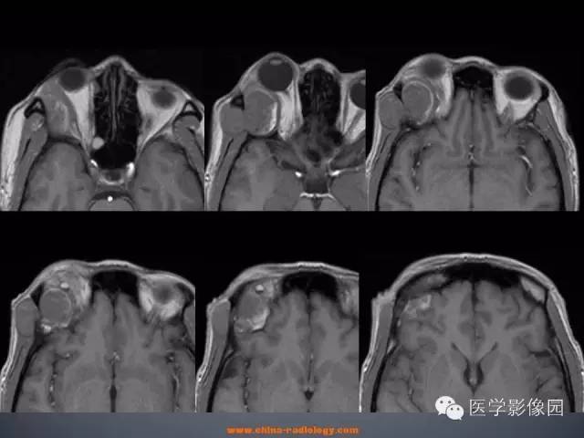 【病例】眼眶表皮样囊肿1例CT及MR影像表现